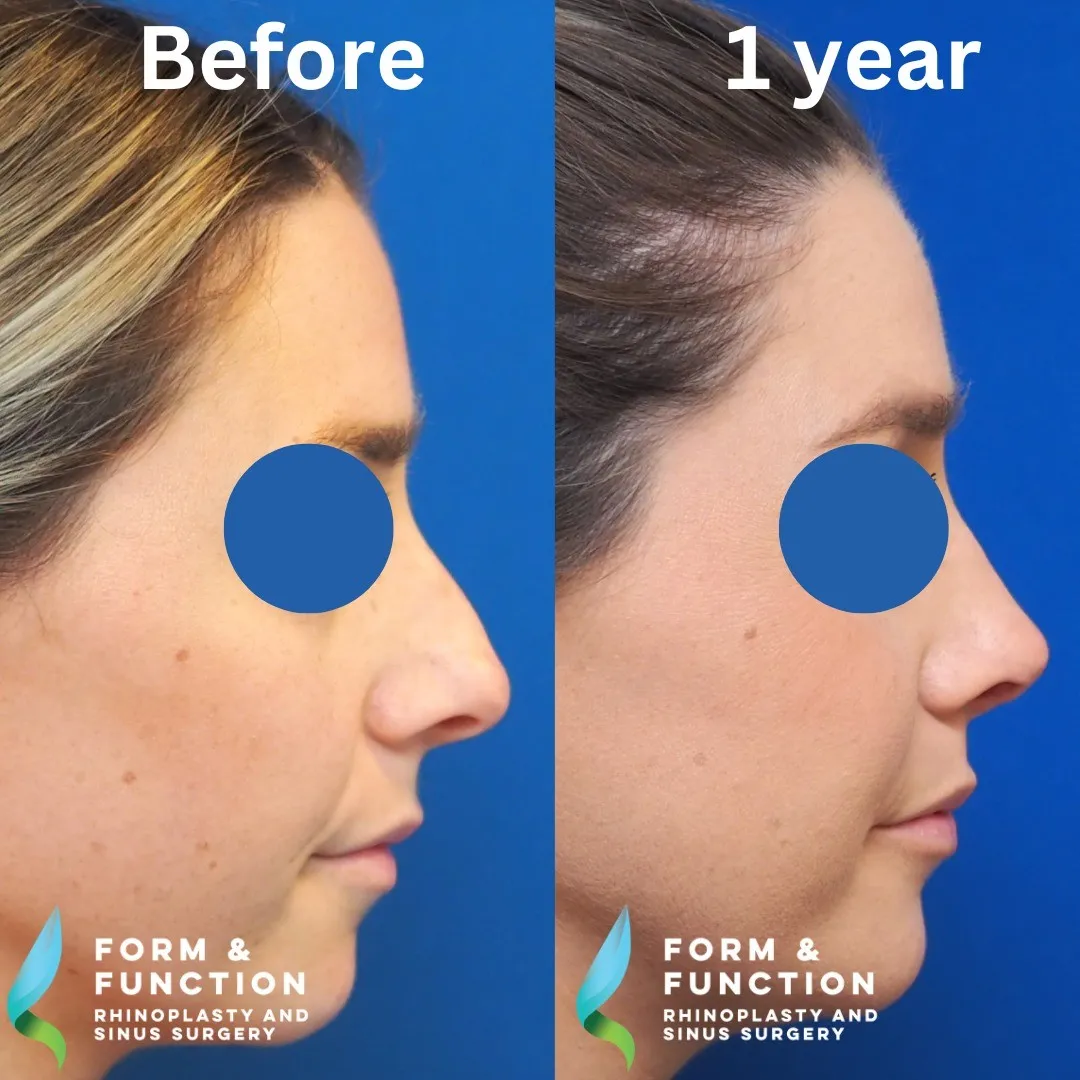 Before and after, left profile, 1 year after rhinoplasty with septal reconstruction