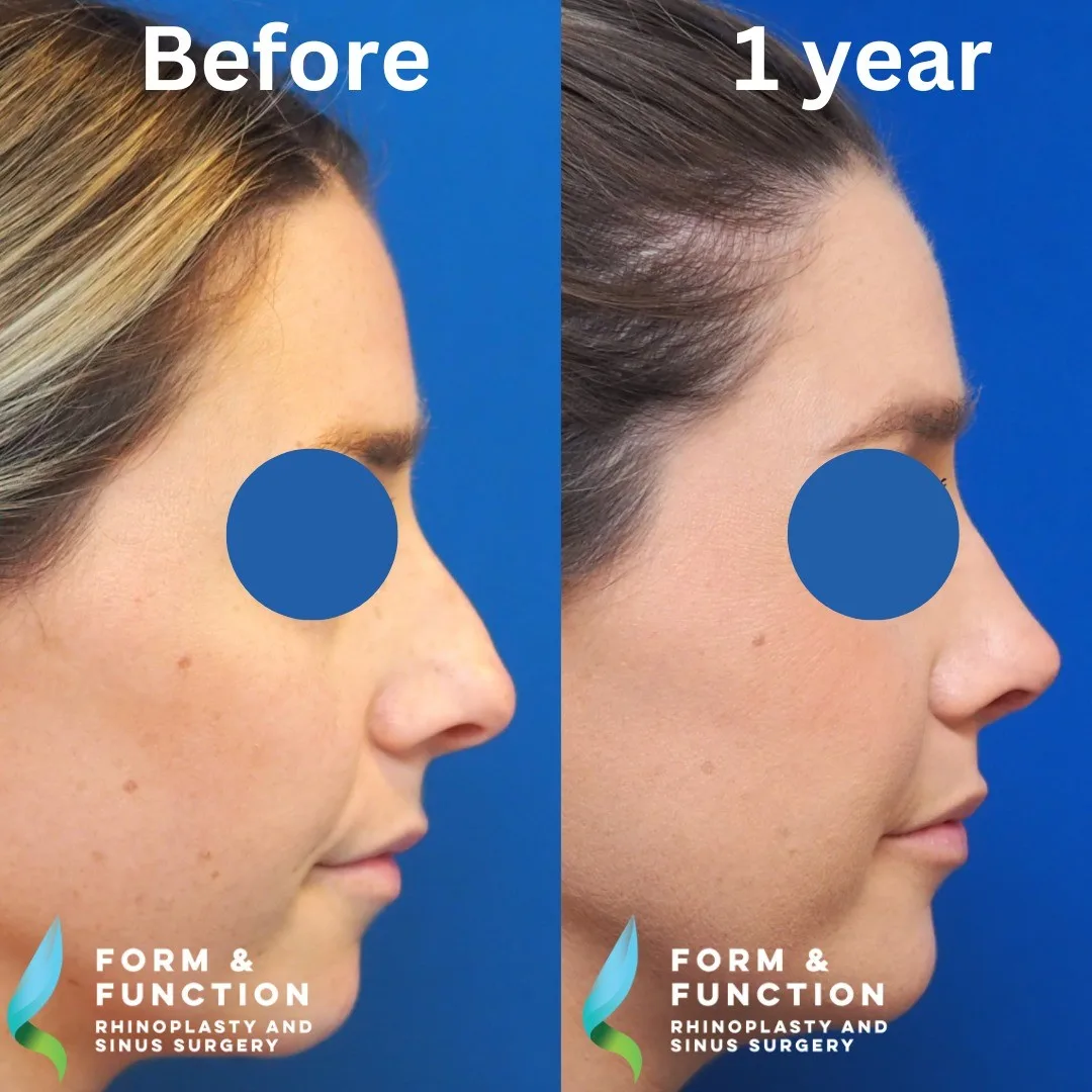 Before and after, left profile, 1 year after rhinoplasty with septal reconstruction