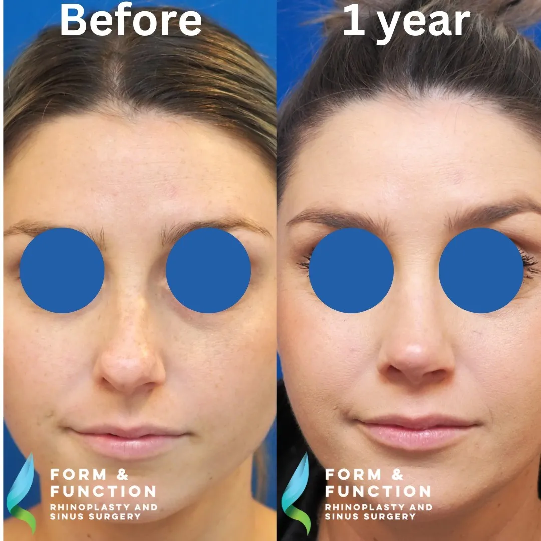 Before and after, frontal view, 1 year after rhinoplasty with septal reconstruction