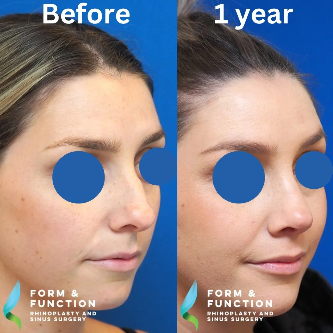 Before and after, right three-quarter view, 1 year after rhinoplasty with septal reconstruction