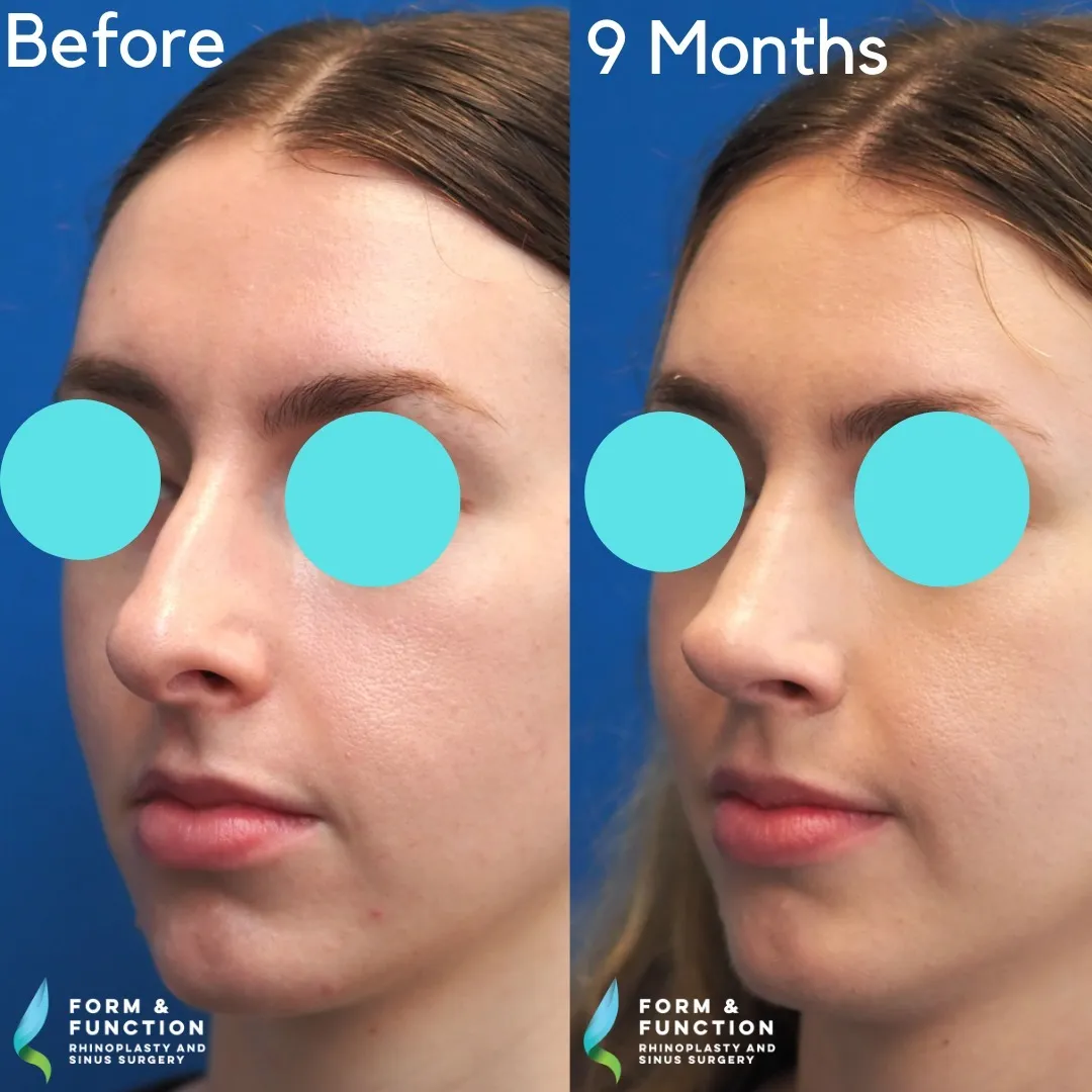 Before and after, left three-quarter view, 9 months after rhinoplasty and septoplasty