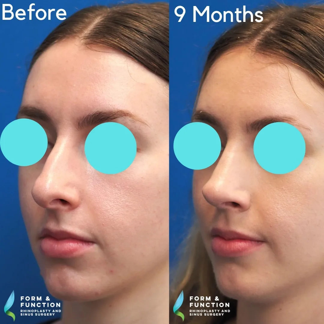 Before and after, left three-quarter view, 9 months after rhinoplasty and septoplasty