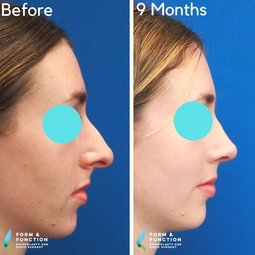 Before and after, right profile, 9 months after rhinoplasty and septoplasty
