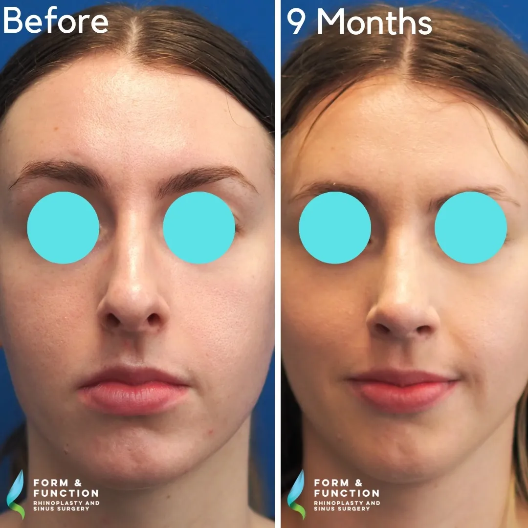 Before and after, frontal view, 9 months after rhinoplasty and septoplasty