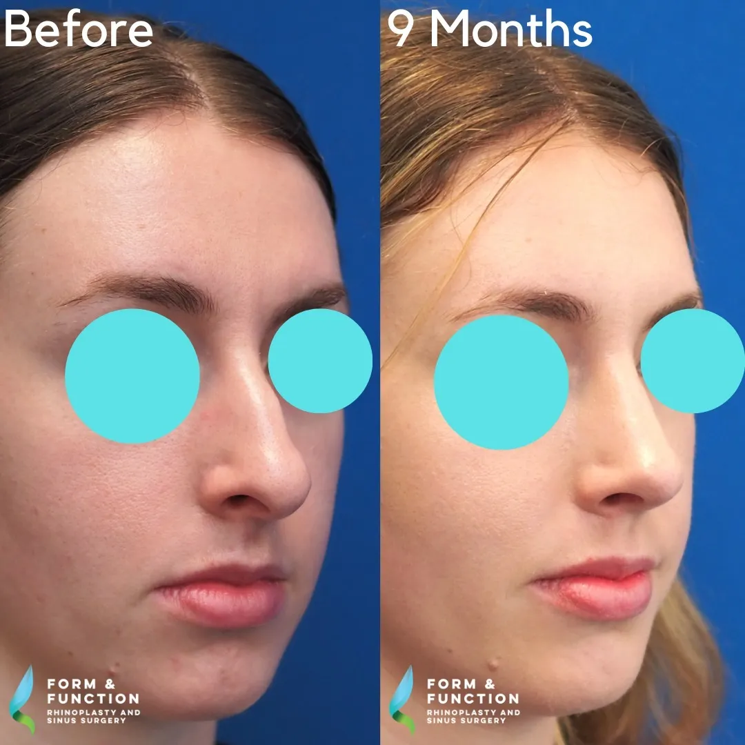 Before and after, right three-quarter view, 9 months after rhinoplasty and septoplasty