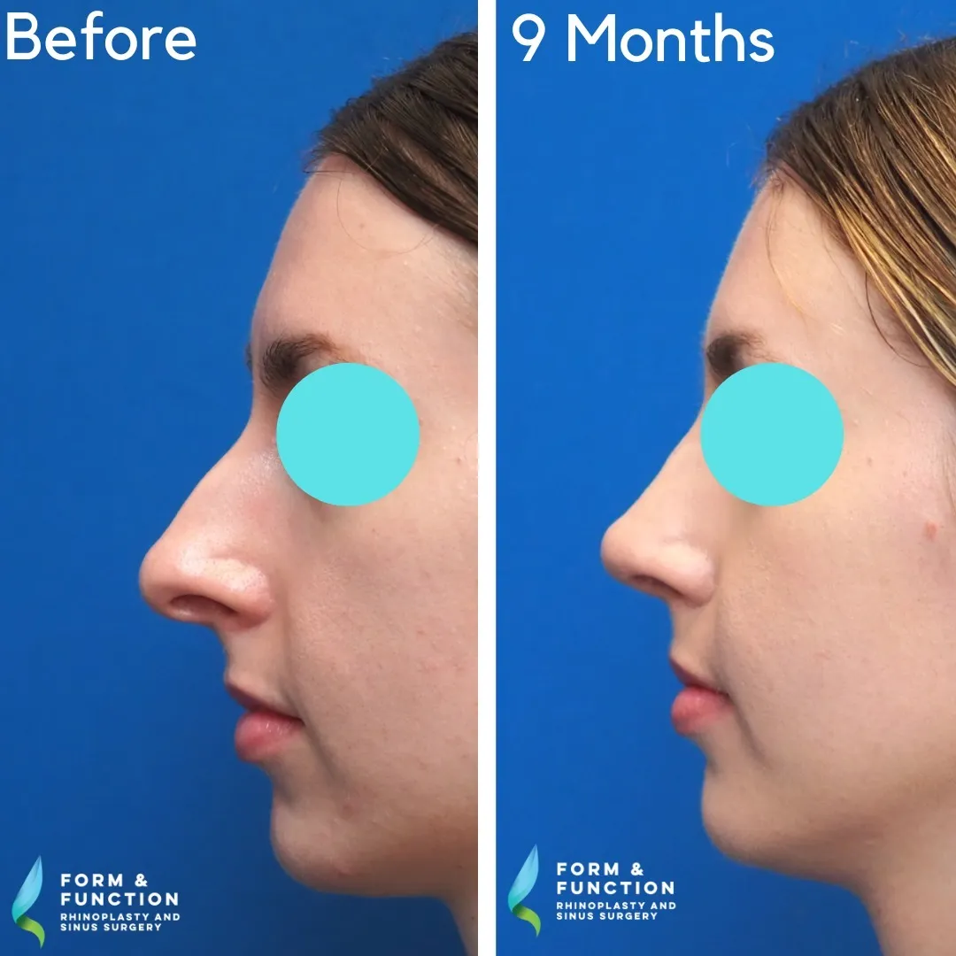 Before and after, 9 months after rhinoplasty and septoplasty (photograph 5 of 5)