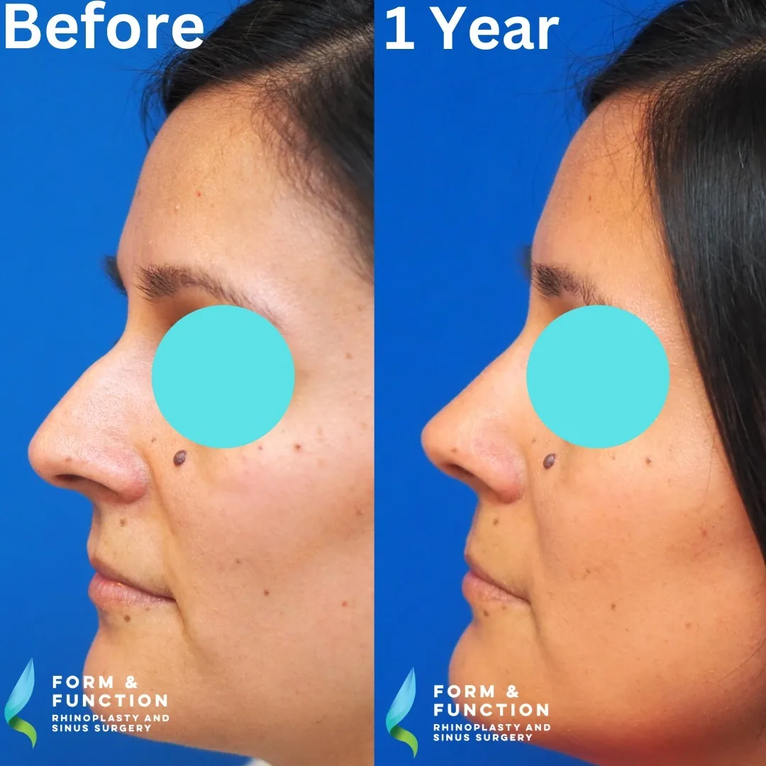 Before and after, left profile, 1 year after rhinoplasty and septoplasty