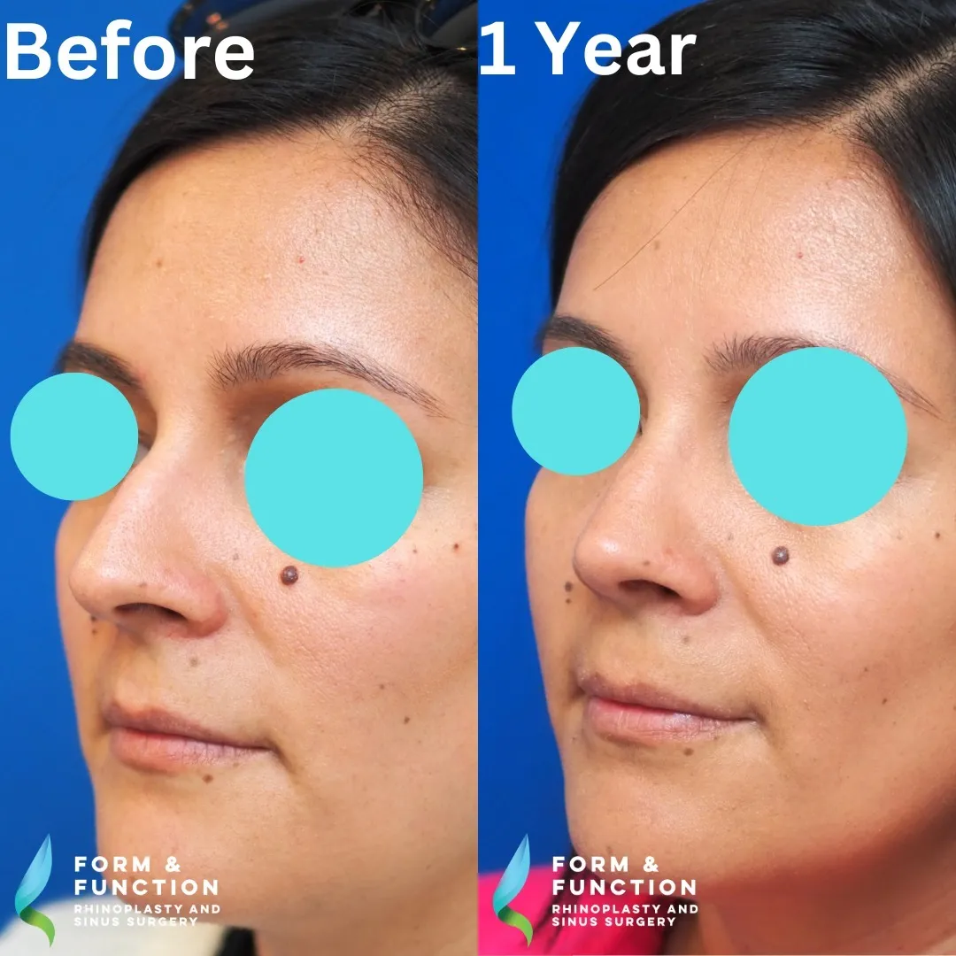 Before and after, left three-quarter view, 1 year after rhinoplasty and septoplasty