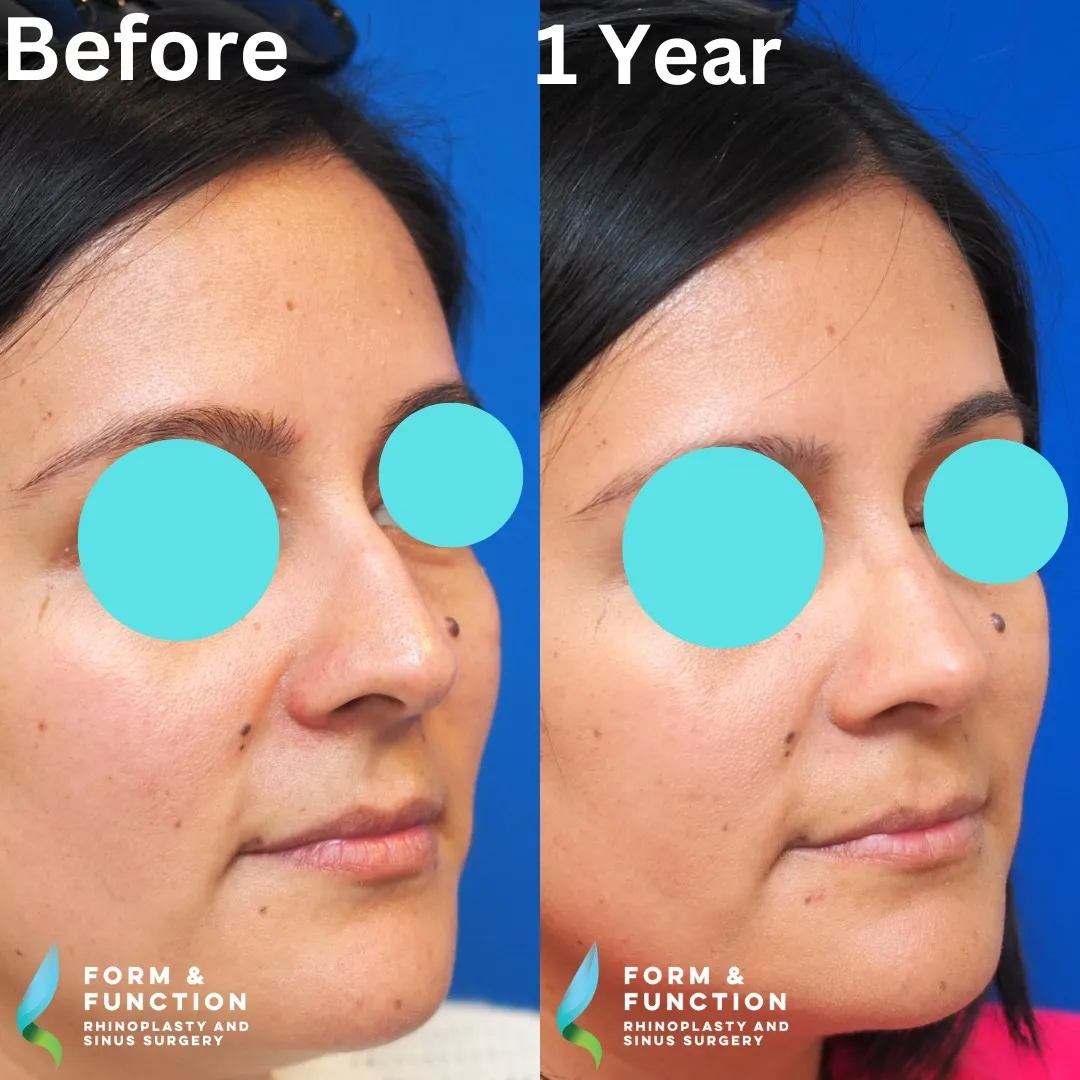 Before and after, 1 year after rhinoplasty and septoplasty (photograph 3 of 6)