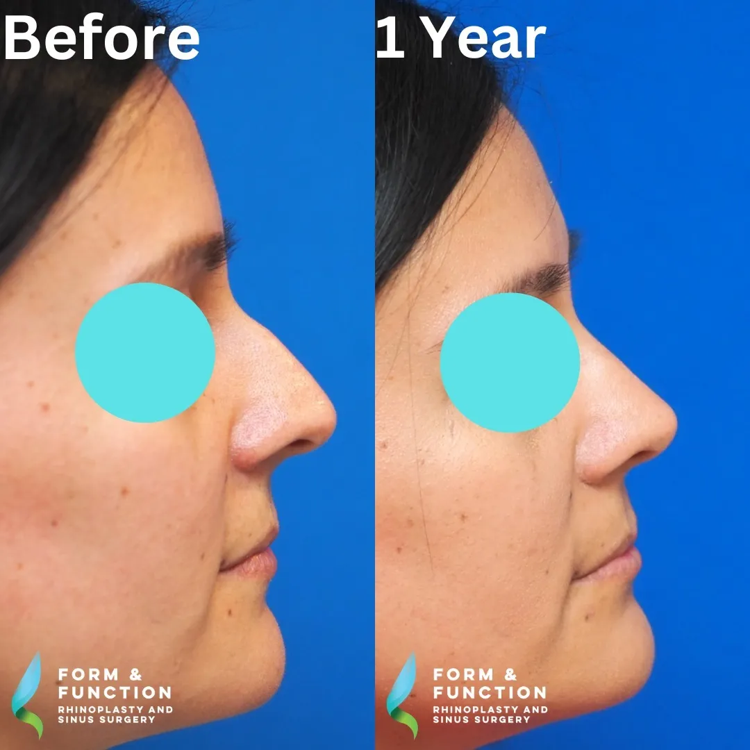 Before and after, right profile, 1 year after rhinoplasty and septoplasty