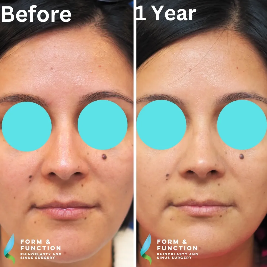 Before and after, frontal view, 1 year after rhinoplasty and septoplasty