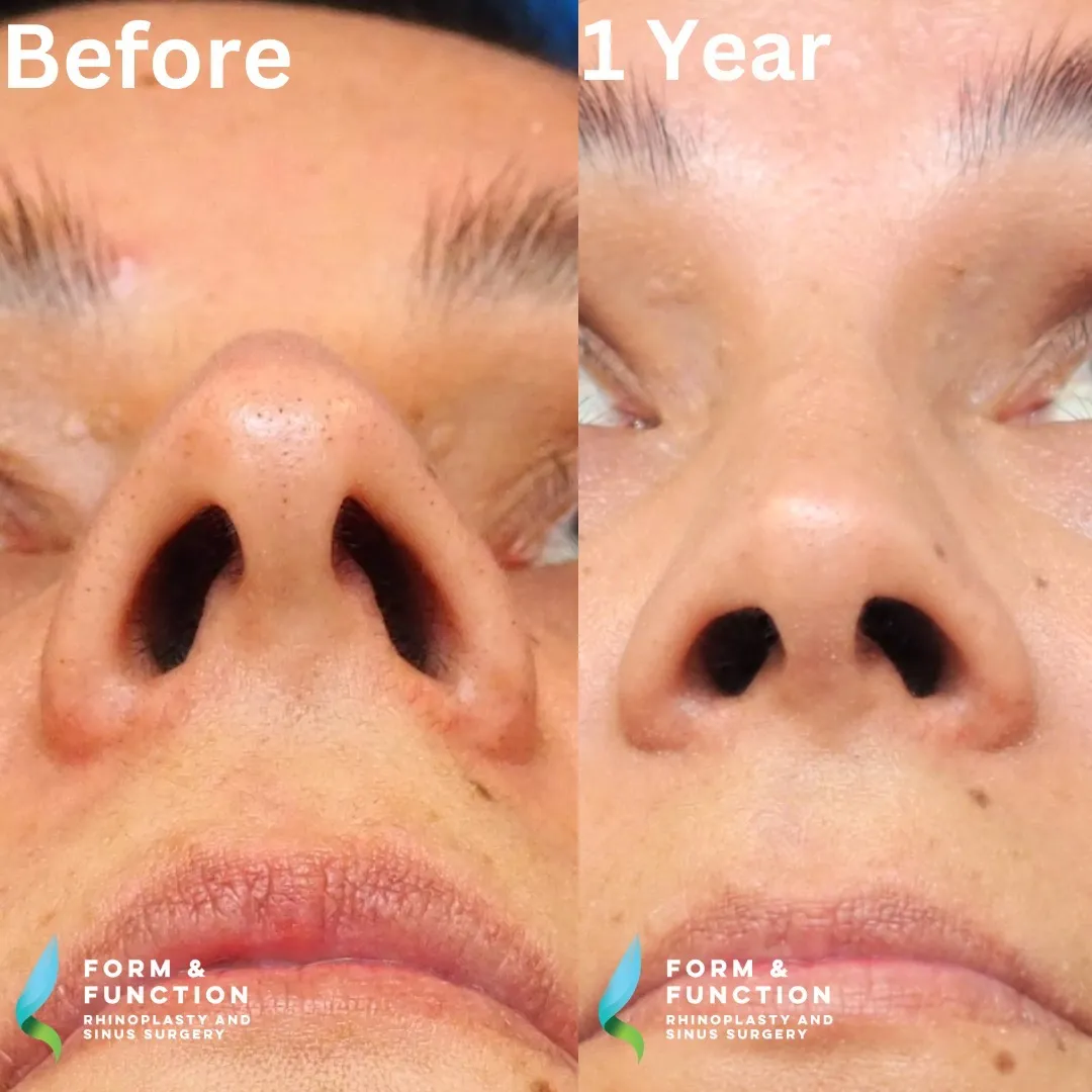 Before and after, base view, 1 year after rhinoplasty and septoplasty