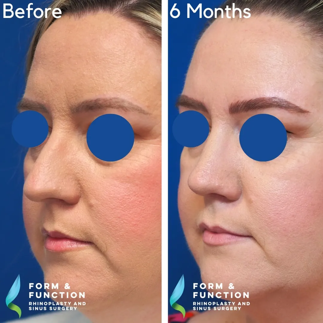 Before and after, 6 months after septorhinoplasty (photograph 1 of 5)