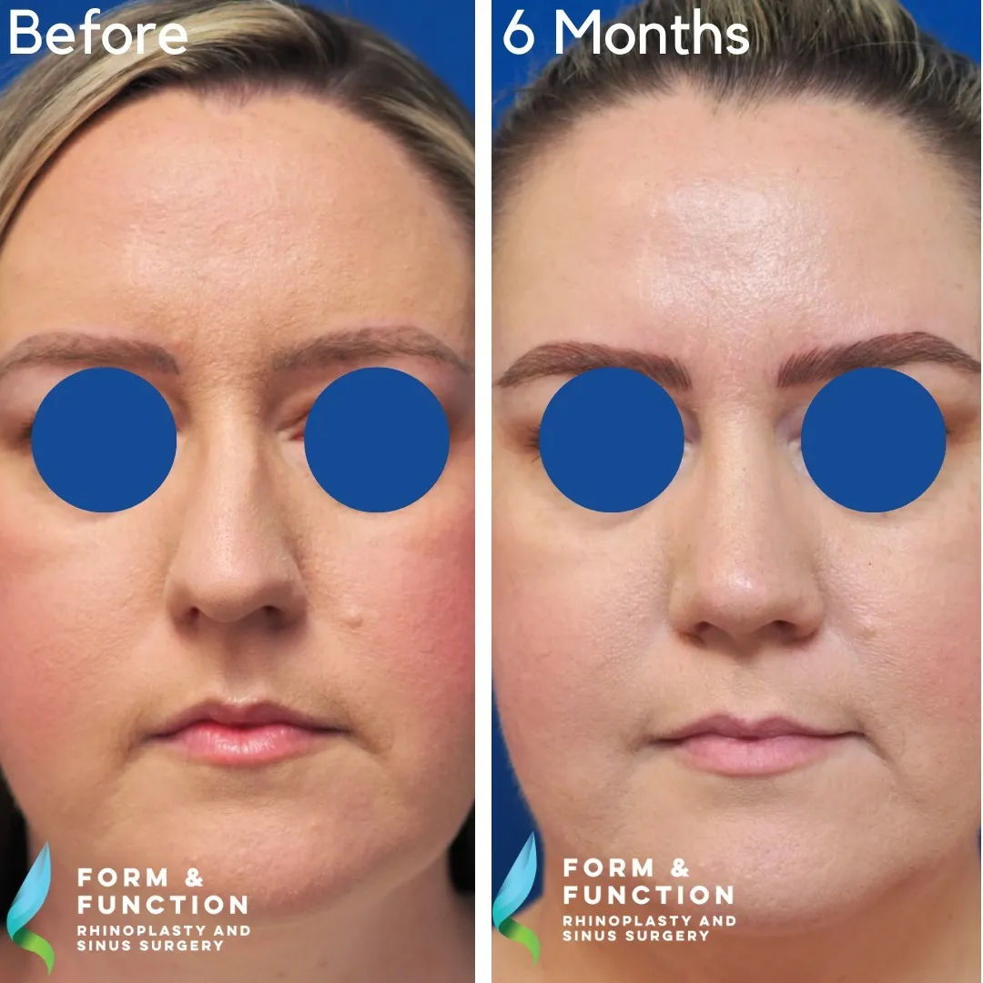 Before and after, 6 months after septorhinoplasty (photograph 2 of 5)
