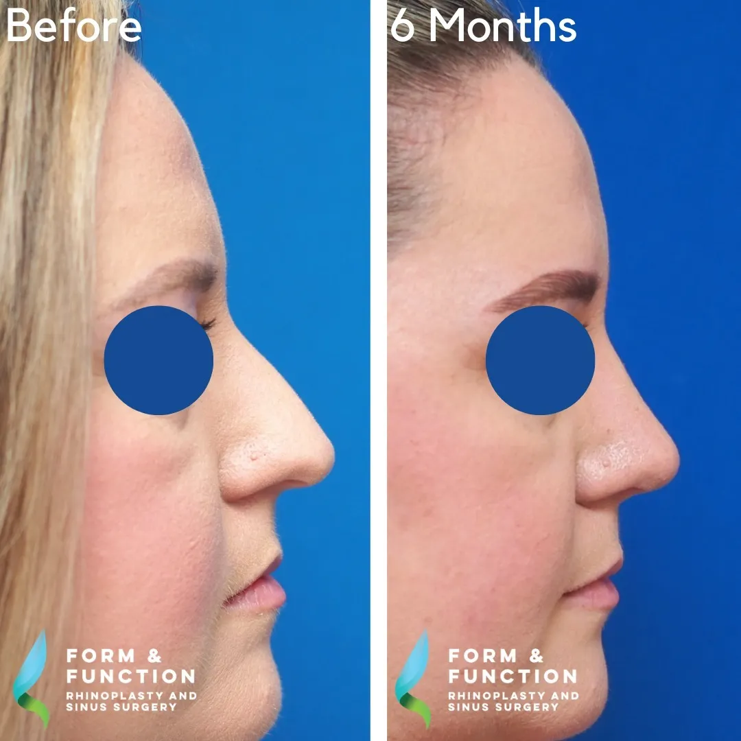 Before and after, 6 months after septorhinoplasty (photograph 3 of 5)