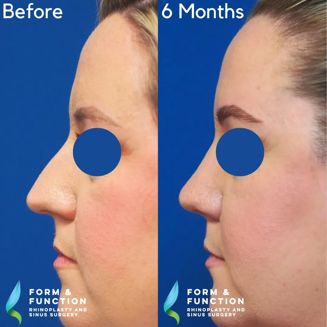 Before and after, 6 months after septorhinoplasty (photograph 4 of 5)