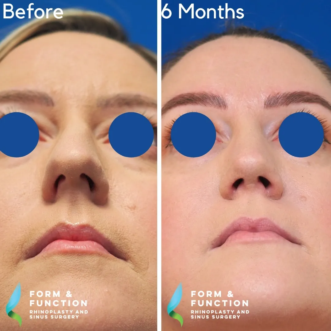 Before and after, 6 months after septorhinoplasty (photograph 5 of 5)