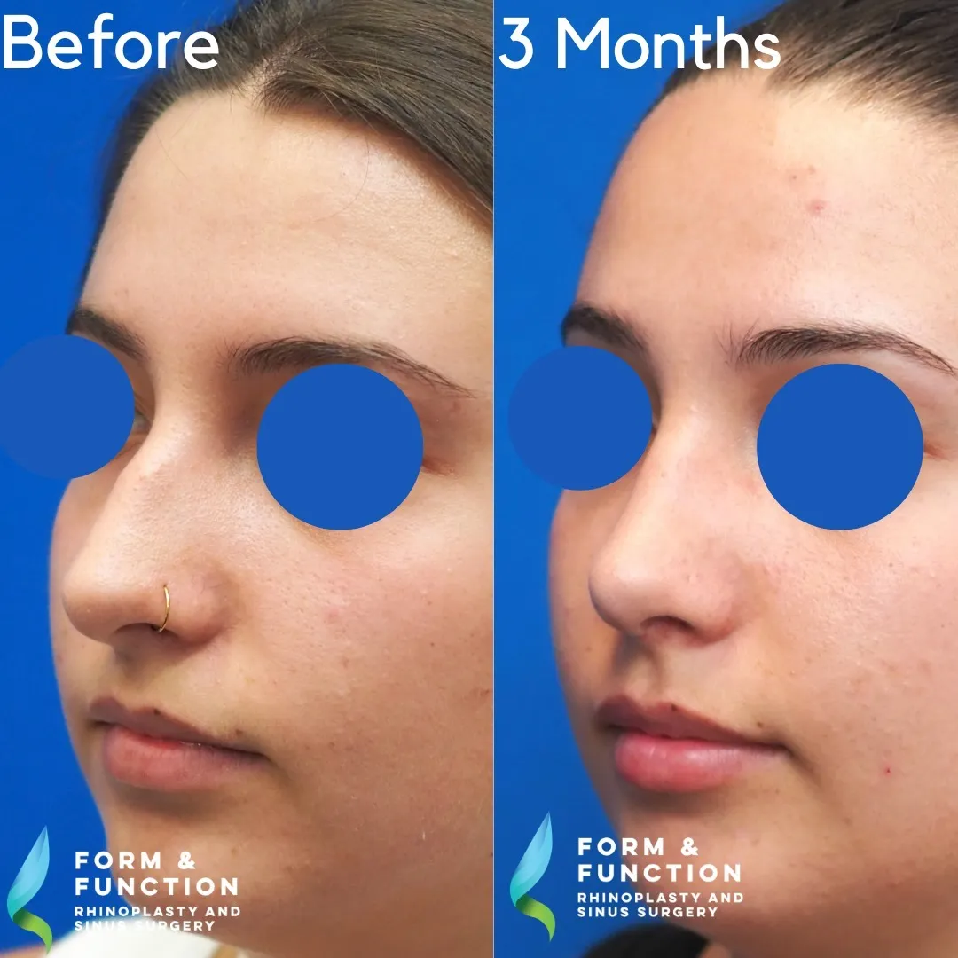 Before and after, 3 months after rhinoplasty (photograph 1 of 3)
