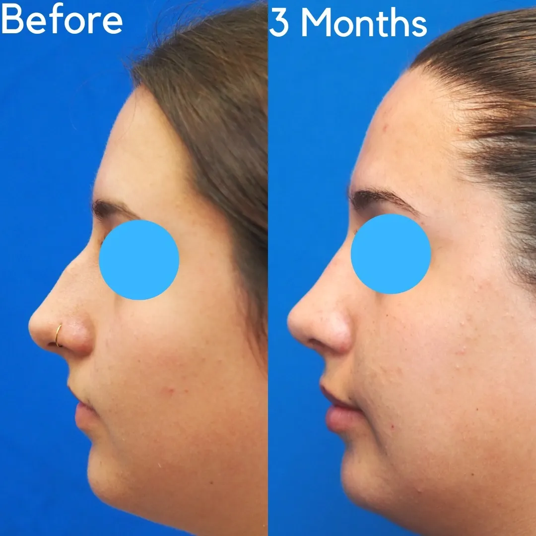 Before and after, 3 months after rhinoplasty (photograph 2 of 3)