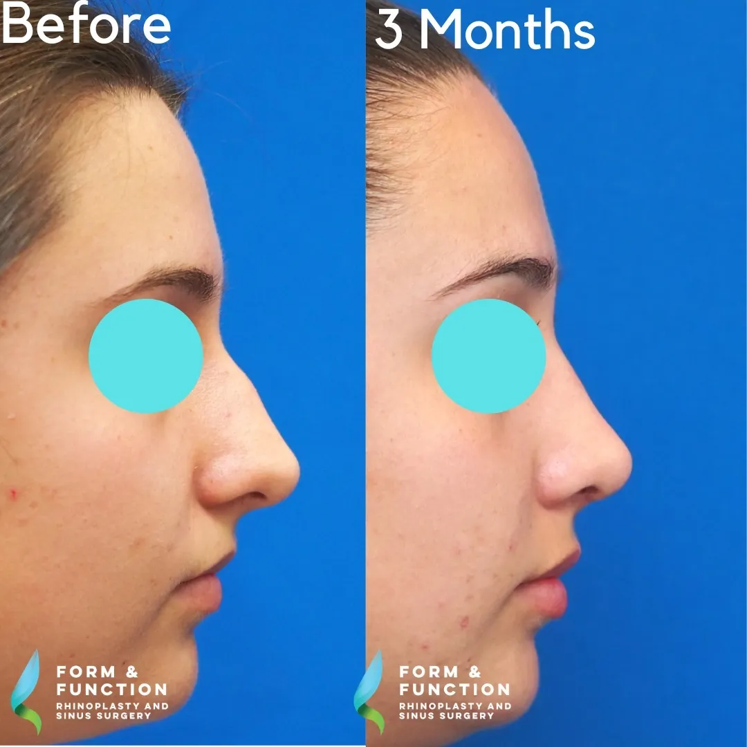 Before and after, 3 months after rhinoplasty (photograph 3 of 3)