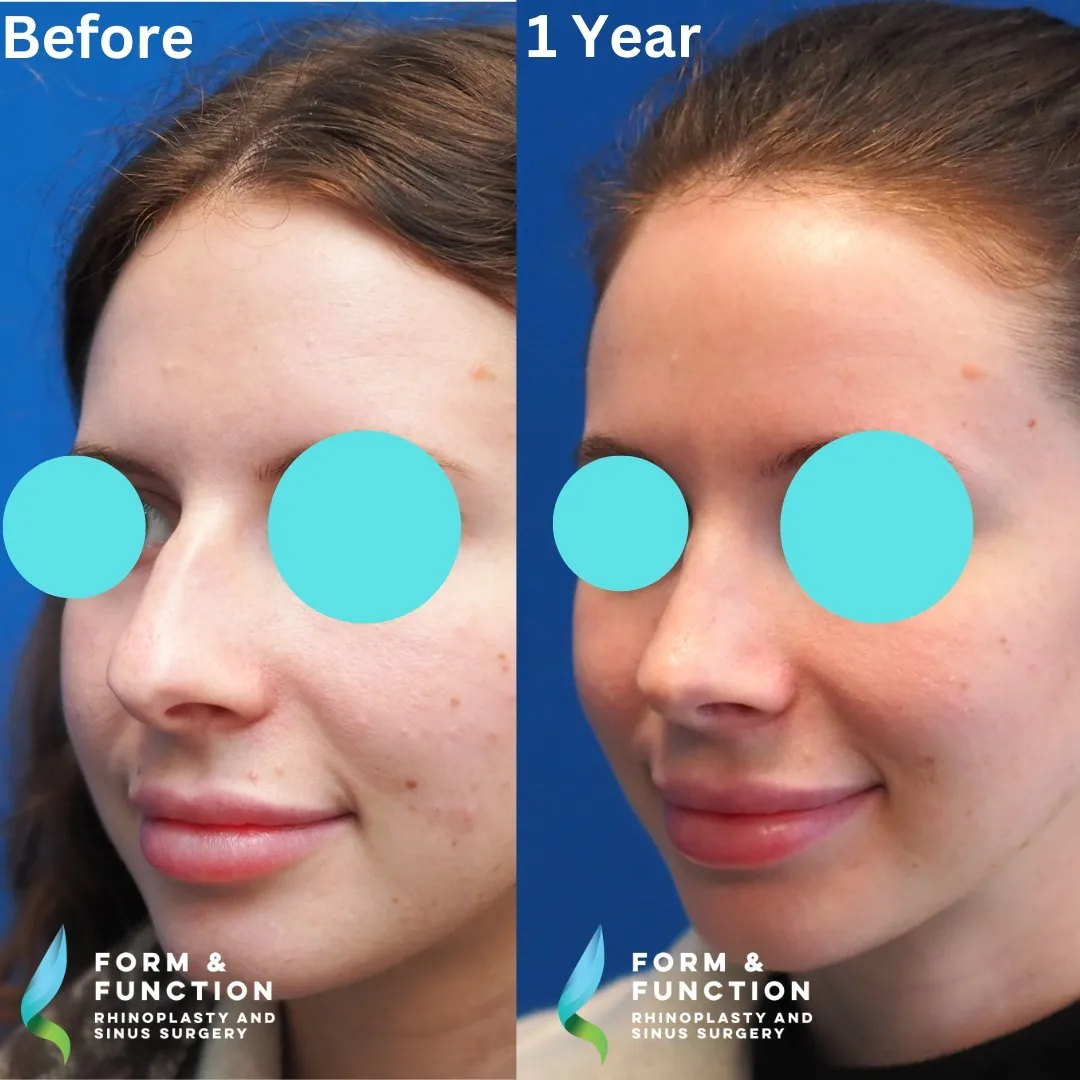 Before and after, left three-quarter view, 1 year after rhinoplasty and septoplasty