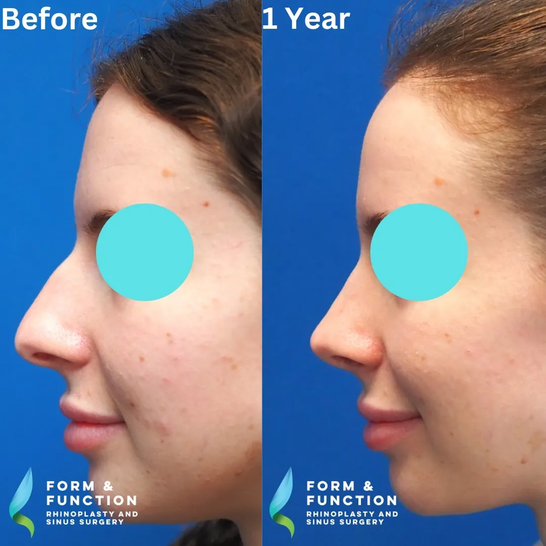 Before and after, left profile, 1 year after rhinoplasty and septoplasty