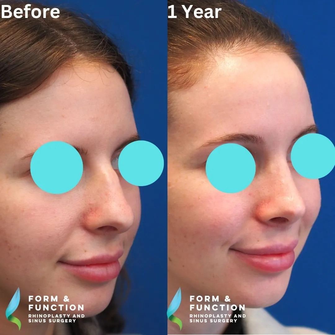 Before and after, right three-quarter view, 1 year after rhinoplasty and septoplasty