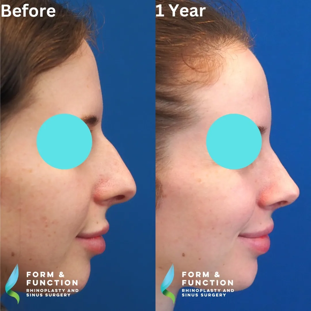 Before and after, right profile, 1 year after rhinoplasty and septoplasty