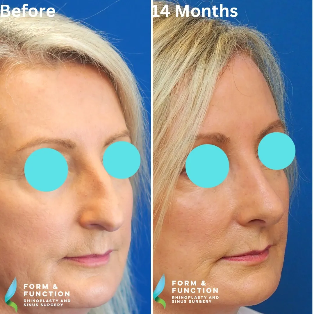Before and after, left three-quarter view, 14 months after rhinoplasty and septoplasty
