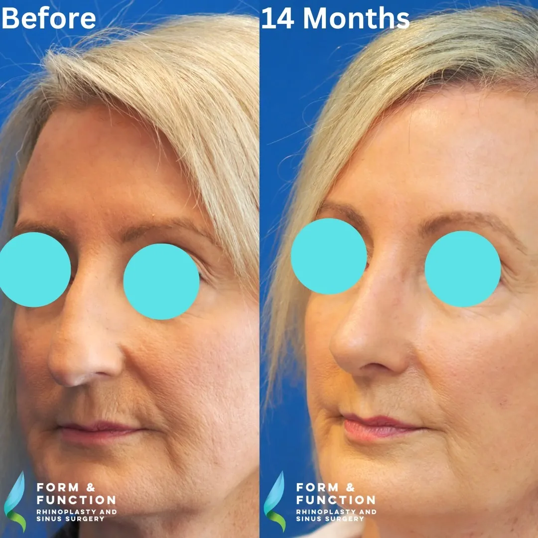 Before and after, frontal view, 14 months after rhinoplasty and septoplasty