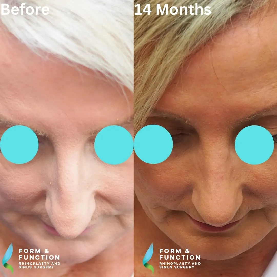 Before and after, 14 months after rhinoplasty and septoplasty (photograph 3 of 5)