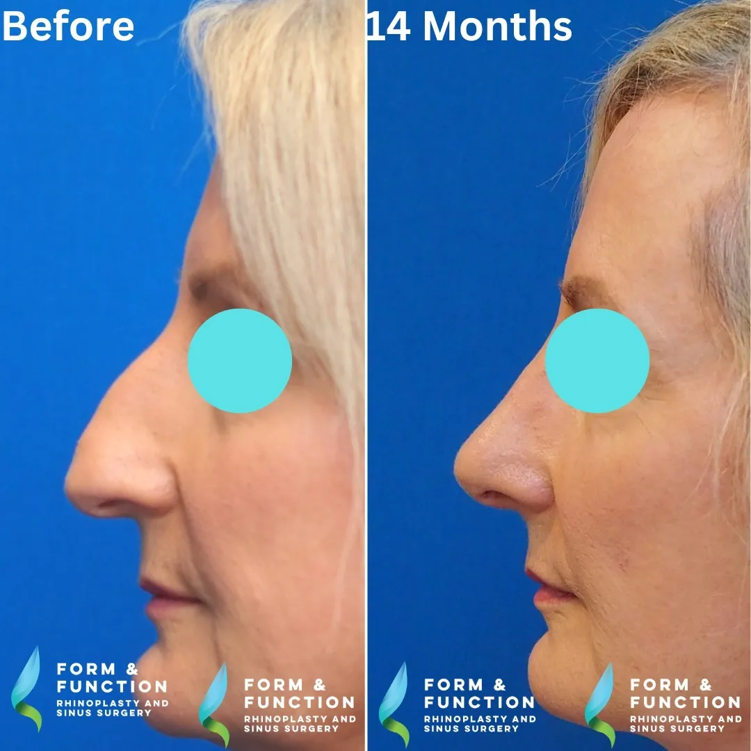 Before and after, left profile, 14 months after rhinoplasty and septoplasty