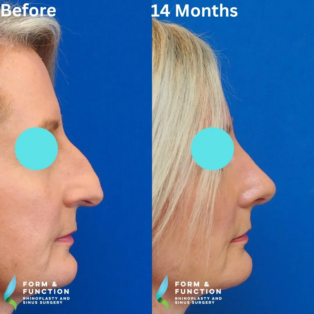 Before and after, right profile, 14 months after rhinoplasty and septoplasty
