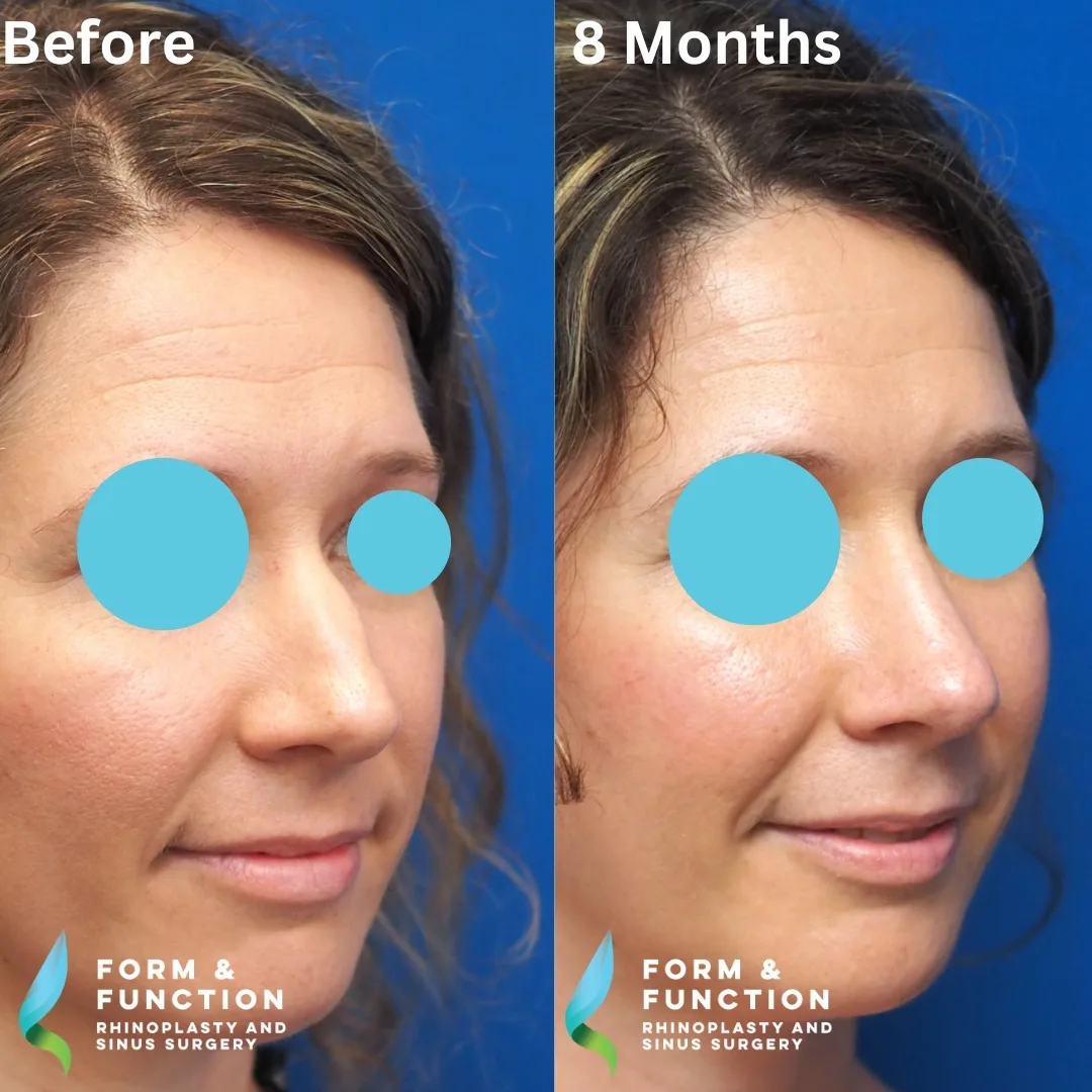 Before and after, left three-quarter view, 8 months after septorhinoplasty