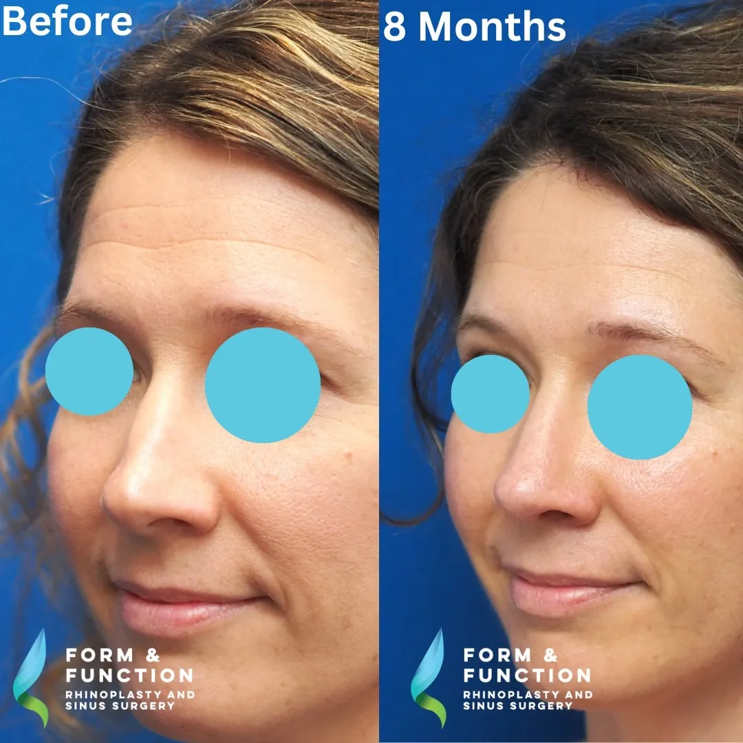 Before and after, frontal view, 8 months after septorhinoplasty