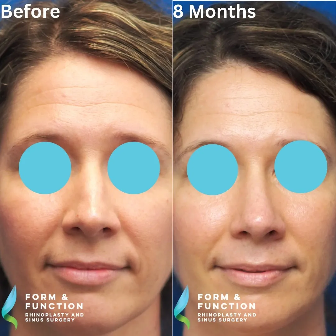 Before and after, 8 months after septorhinoplasty (photograph 3 of 4)