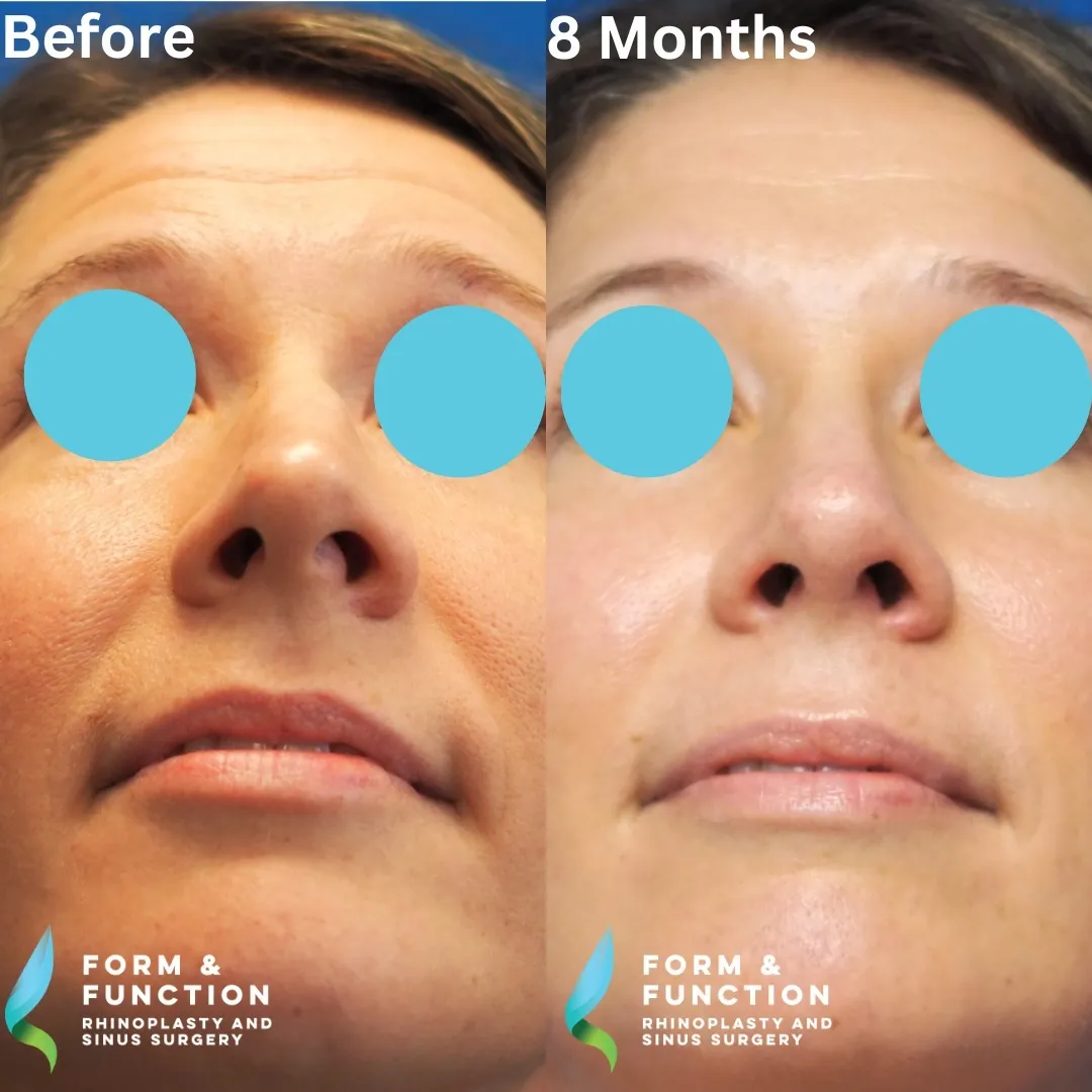 Before and after, base view, 8 months after septorhinoplasty