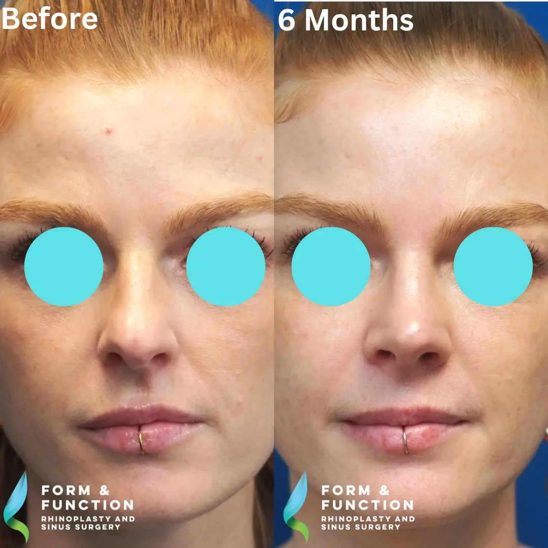 Before and after, frontal view, 6 months after rhinoplasty and septoplasty
