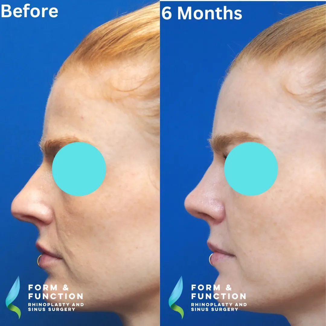 Before and after, left profile, 6 months after rhinoplasty and septoplasty