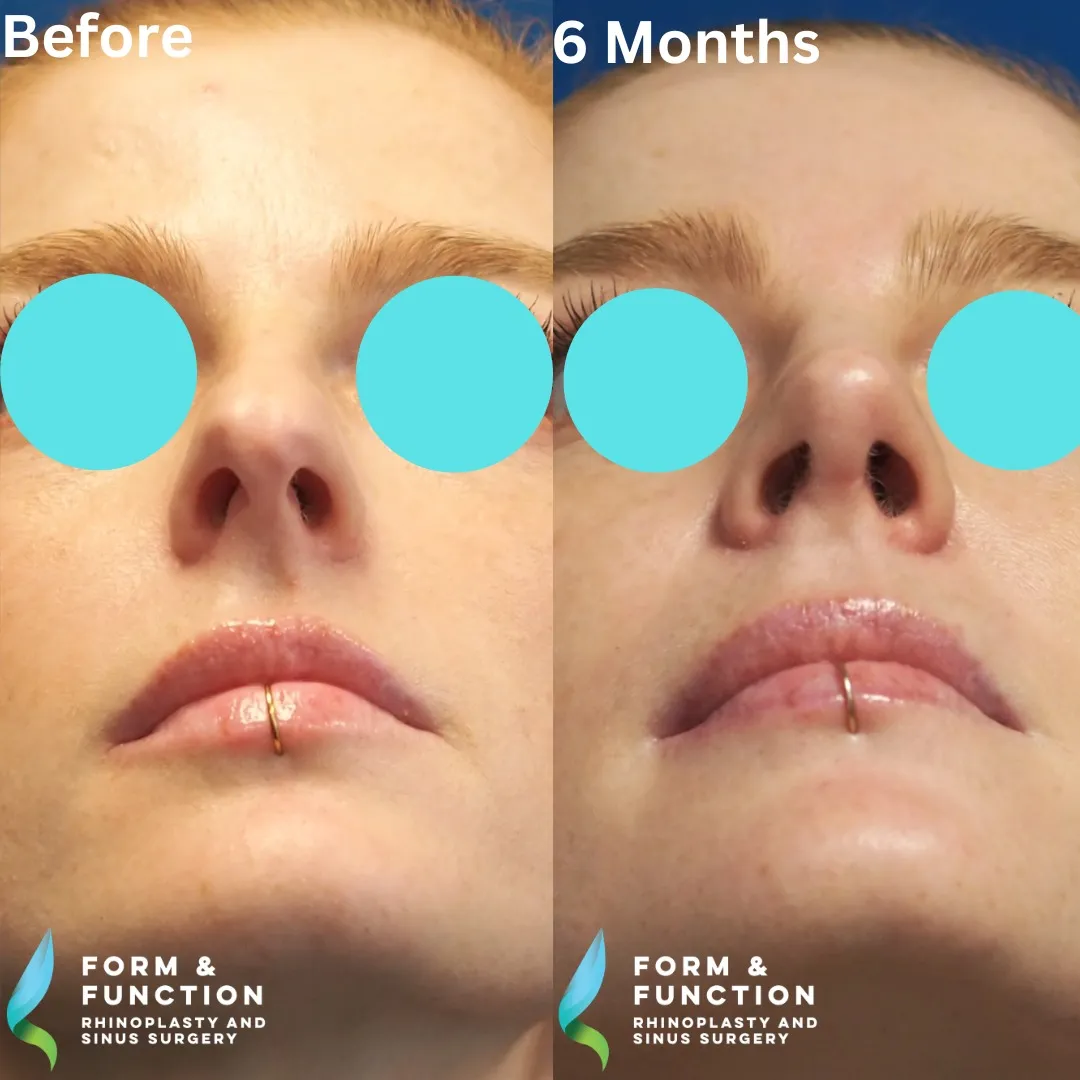 Before and after, base view, 6 months after rhinoplasty and septoplasty