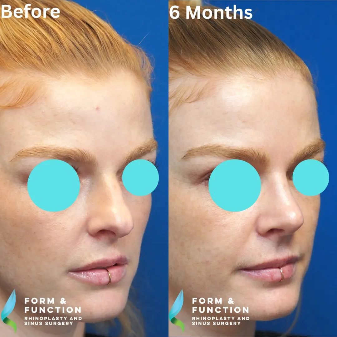 Before and after, left three-quarter view, 6 months after rhinoplasty and septoplasty