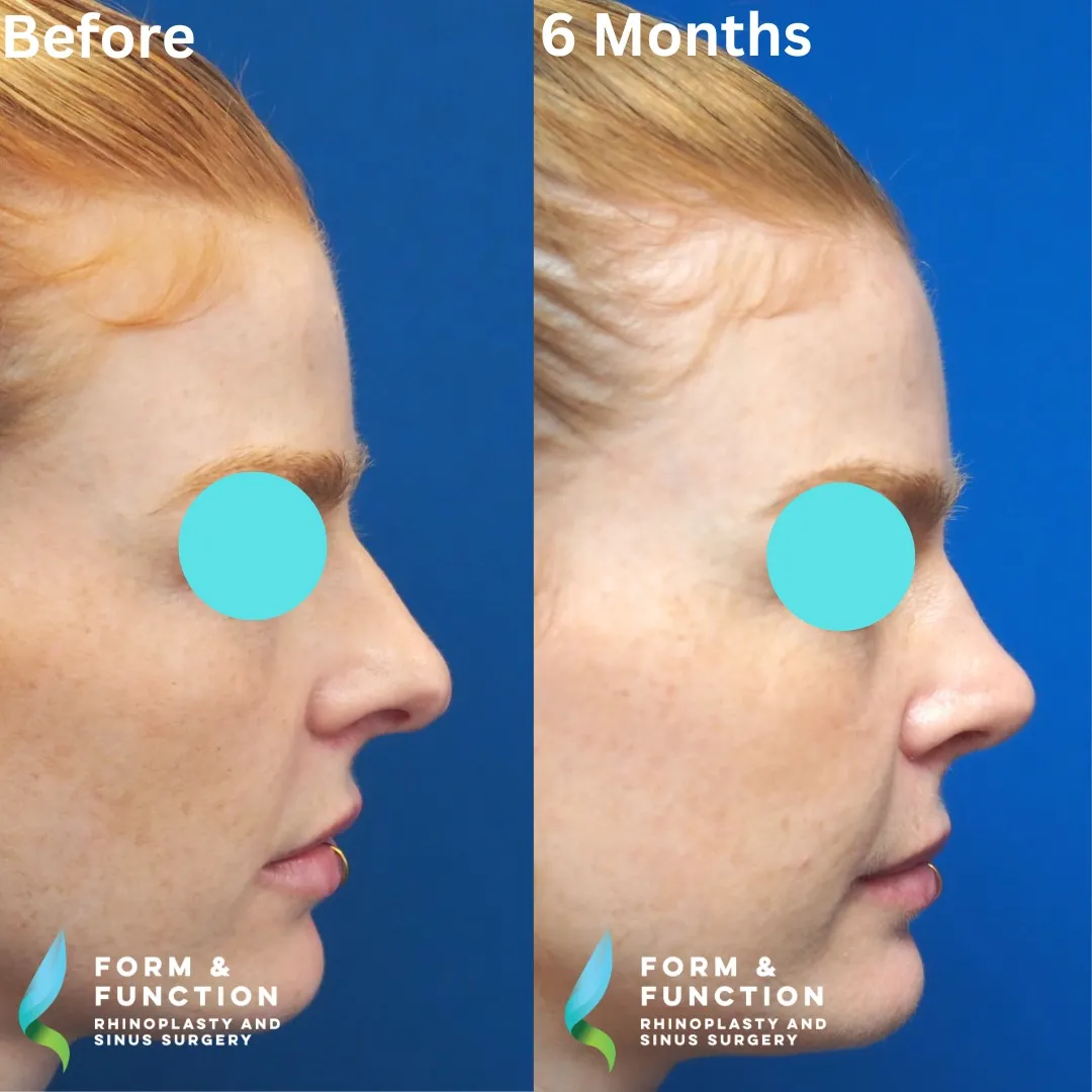 Before and after, right profile, 6 months after rhinoplasty and septoplasty