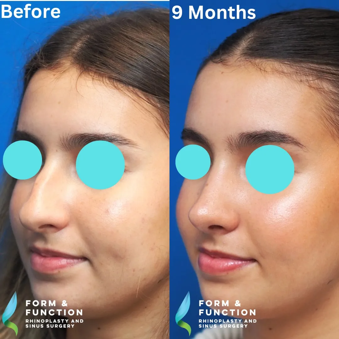 Before and after, left three-quarter view, 9 months after rhinoplasty and septoplasty