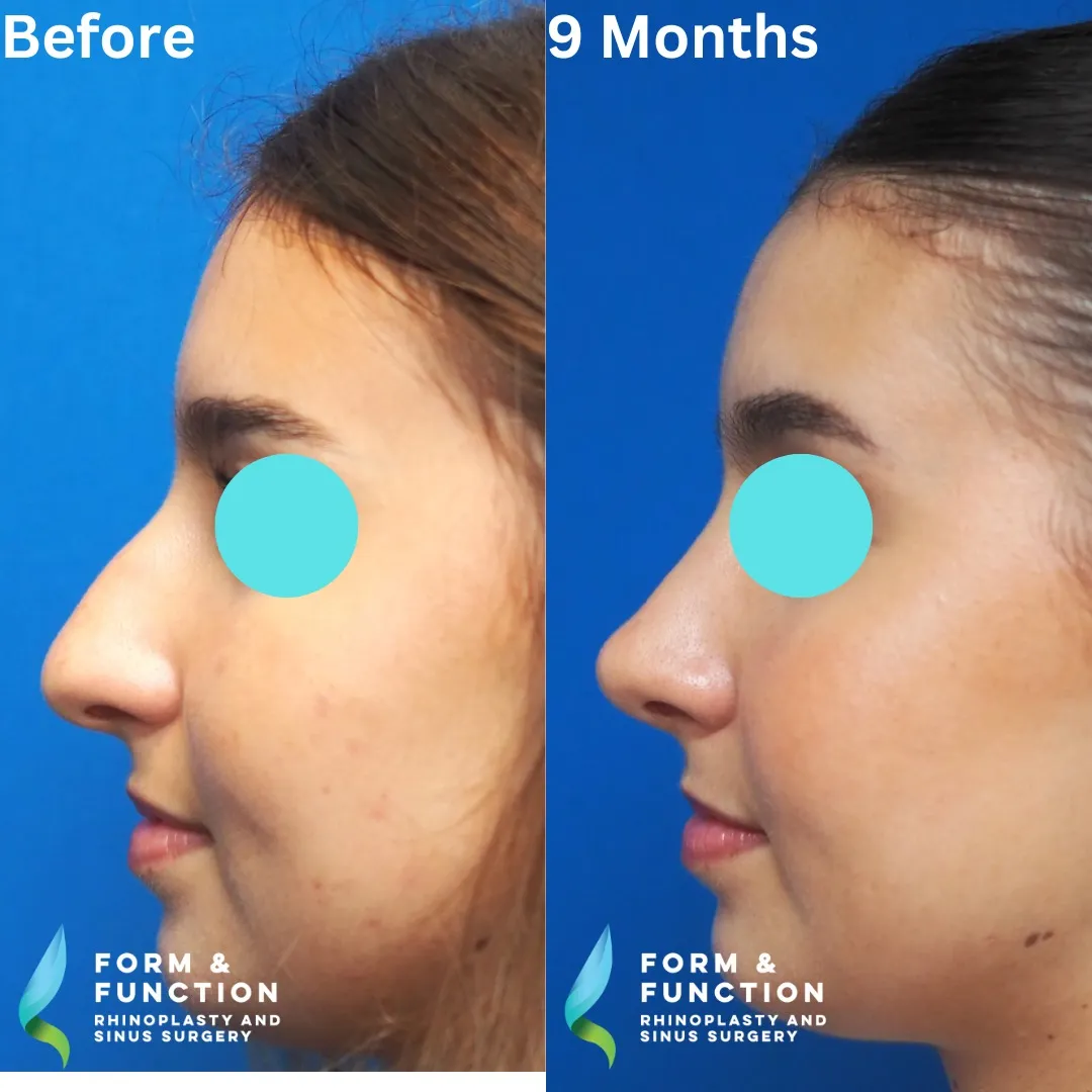 Before and after, right profile, 9 months after rhinoplasty and septoplasty