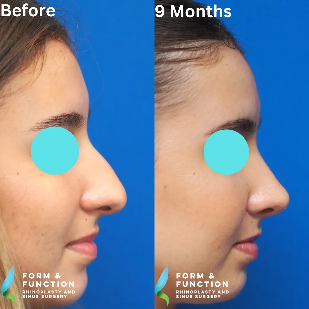 Before and after, 9 months after rhinoplasty and septoplasty (photograph 3 of 5)