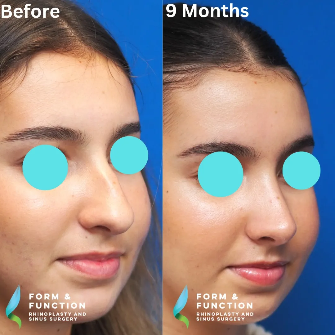 Before and after, 9 months after rhinoplasty and septoplasty (photograph 4 of 5)