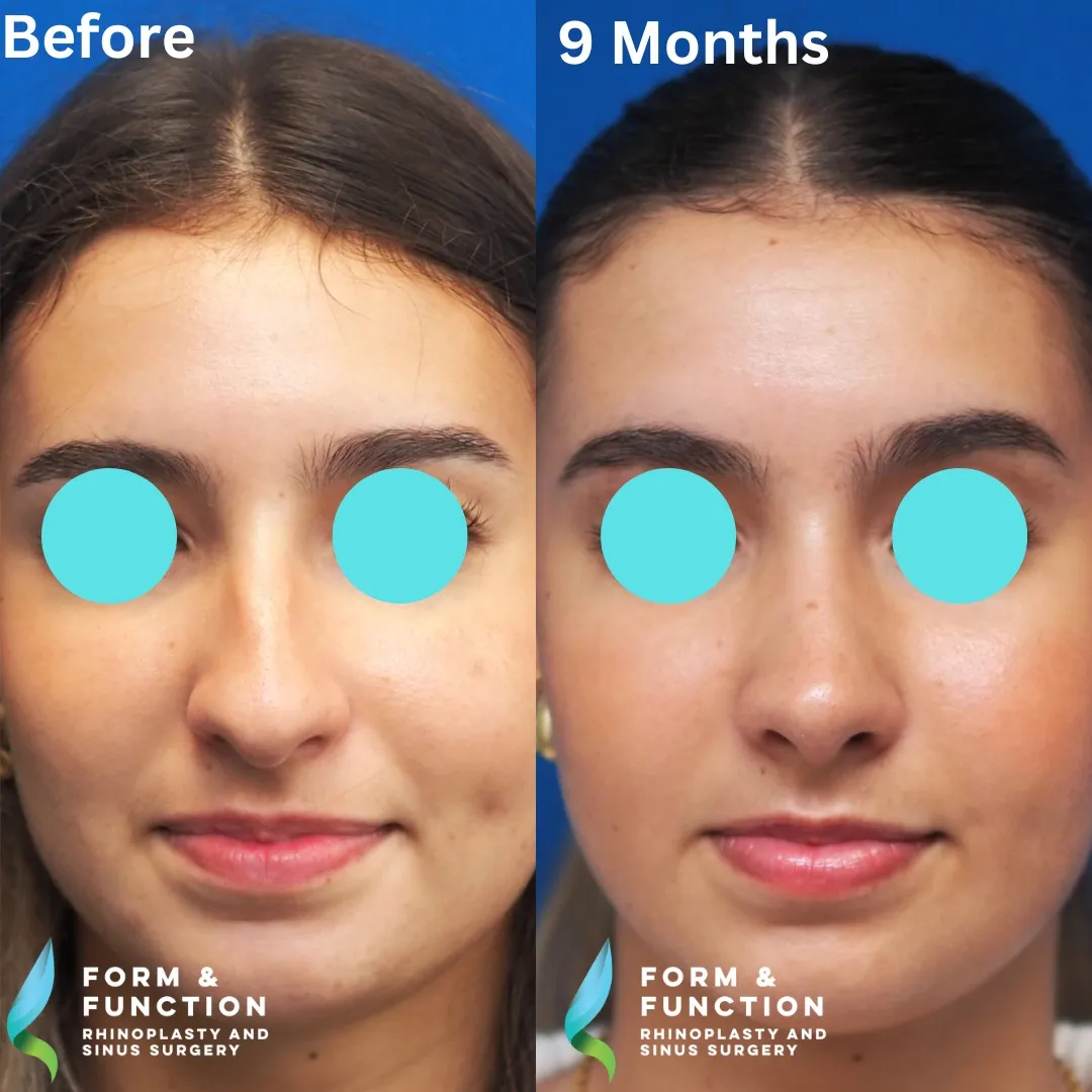 Before and after, frontal view, 9 months after rhinoplasty and septoplasty