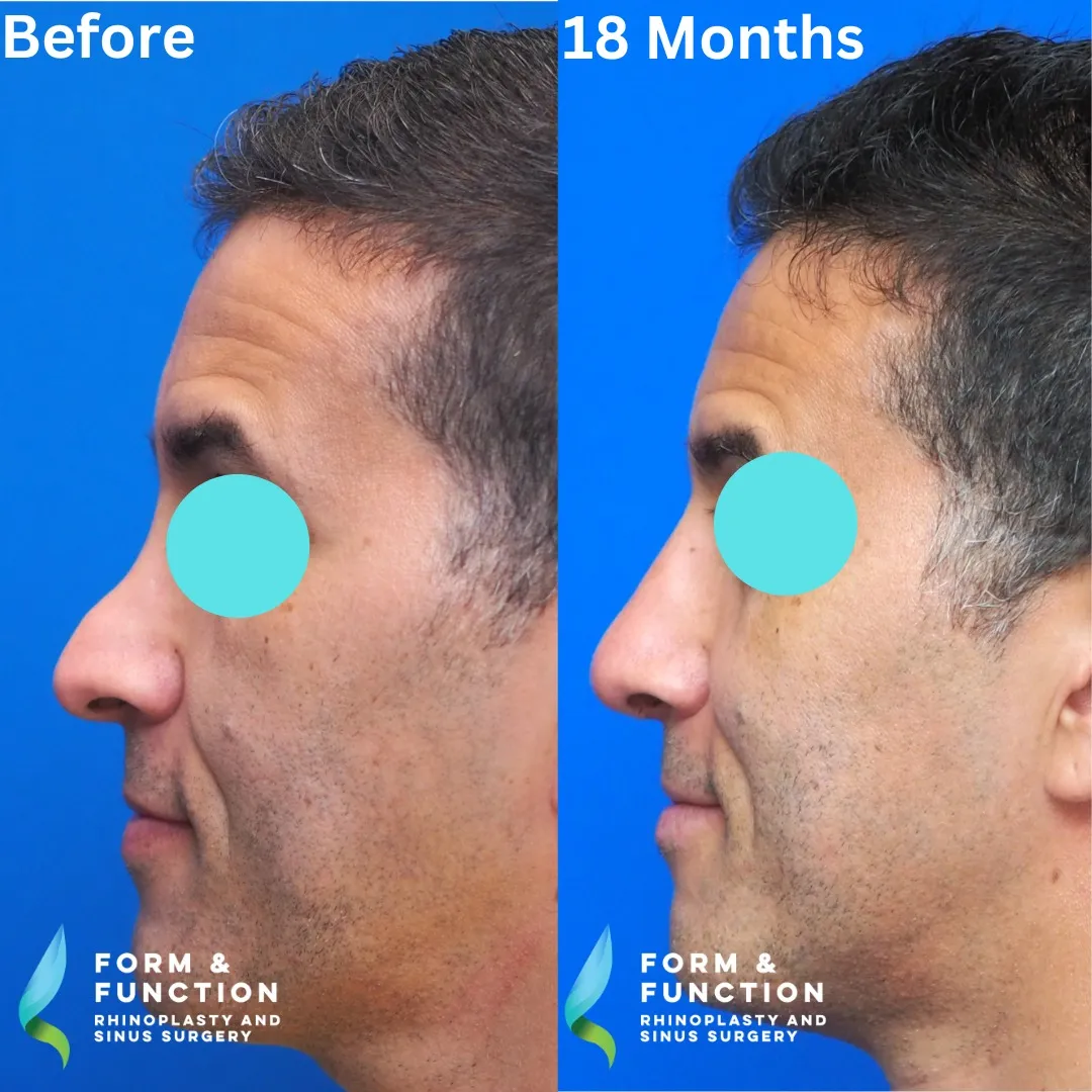 Before and after, left profile, 18 months after revision rhinoplasty with septal reconstruction