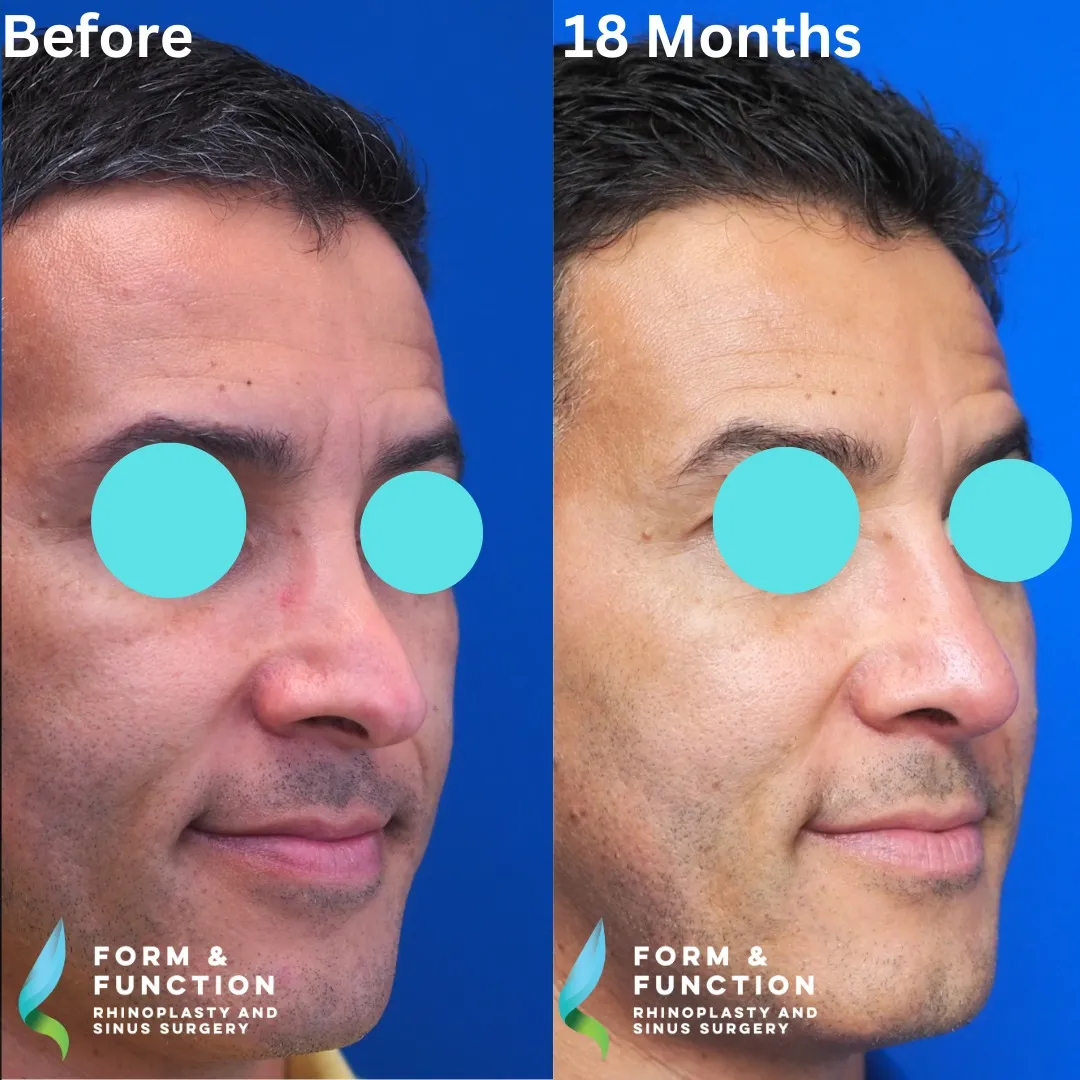 Before and after, left three-quarter view, 18 months after revision rhinoplasty with septal reconstruction