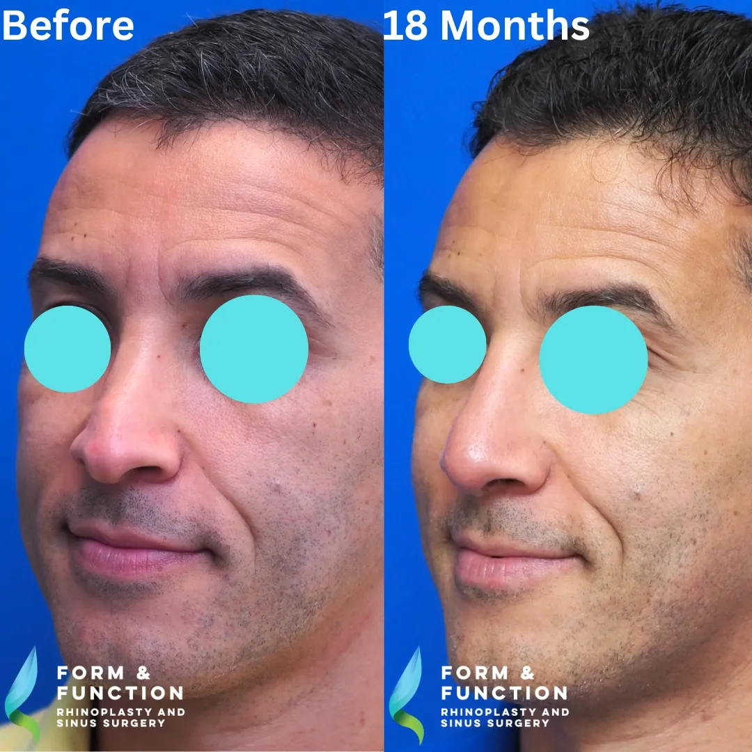 Before and after, frontal view, 18 months after revision rhinoplasty with septal reconstruction